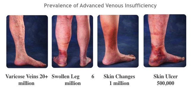 Symptoms of varicose veins